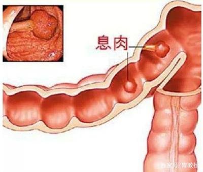 胃肠息肉生长有信号，该预防时要预防！